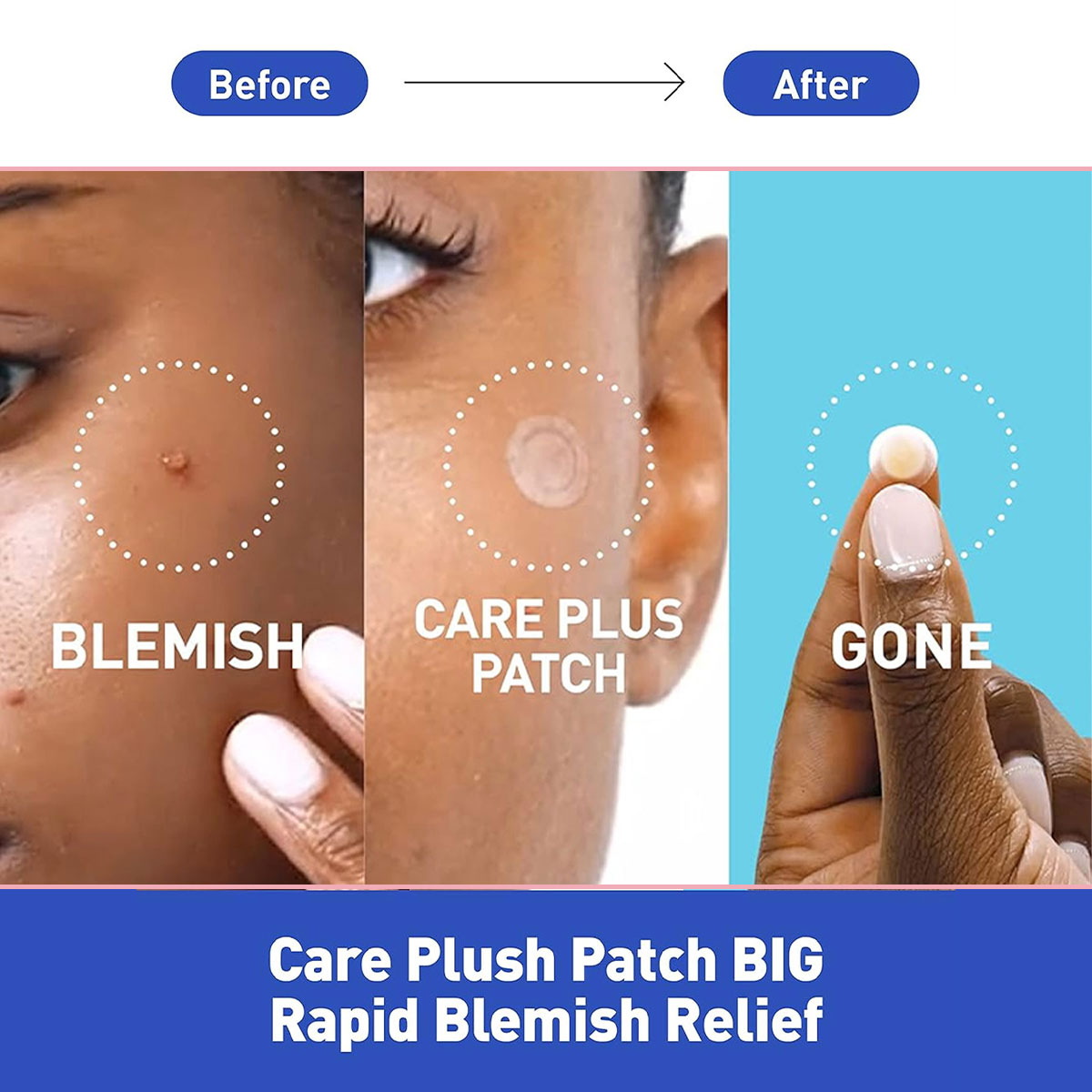 Olive Young Care Plus Spot Cov - đánh giá và giá Skincare Acne