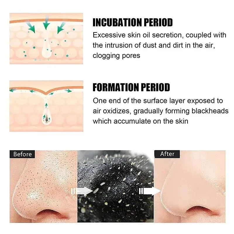10/150PCS Blackhead Remove Mas - đánh giá và giá Charcoal Pore Strip
